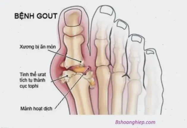 Hiểu về bệnh gout giai đoạn cuối