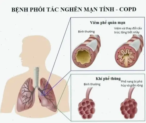 Nguyên nhân và tác động của bệnh