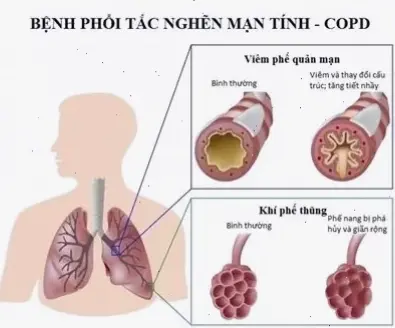 Nguyên nhân và tác động của bệnh