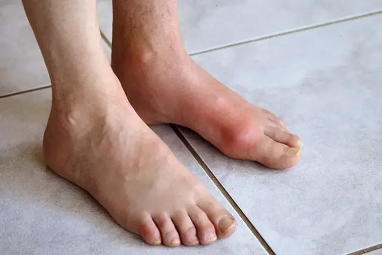 Nguyên nhân và triệu chứng gout cấp tính