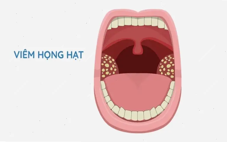 Nguyên nhân và triệu chứng