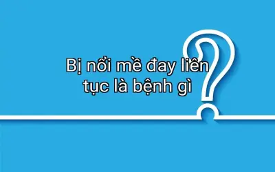 Bị nổi mề đay liên tục là bệnh gì